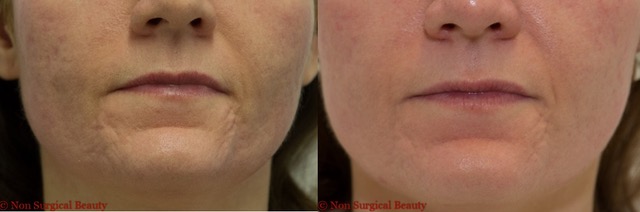 Straight - Before & After